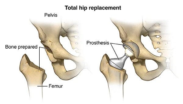 Best hip replacement surgeon in lucknow