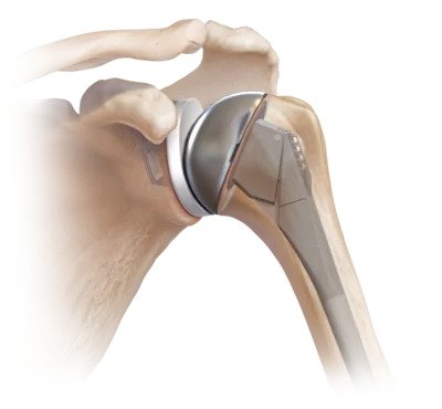 Best Shoulder replacement surgeon in lucknow