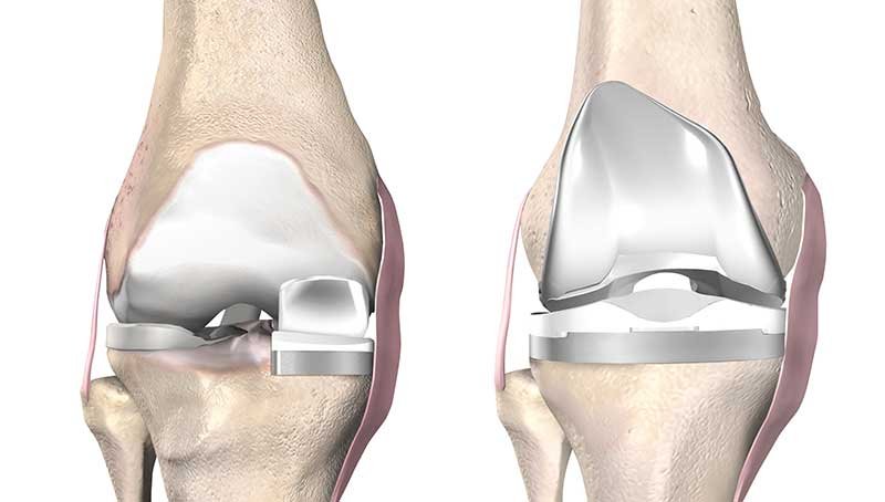  unicondylar knee replacement